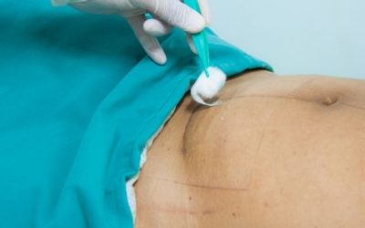 Cesarean Delivery Charges in Panchkula: FAQs for Expecting Parents